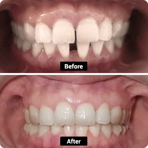 Condition: dents enracinées