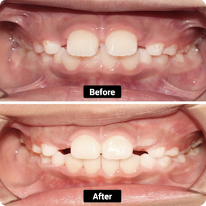 CONDITION: de dents exagérées, surjetées et espacées