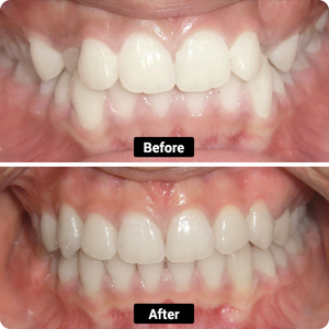 Condition: Crossbite